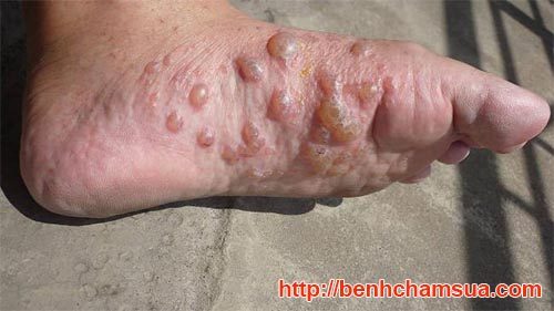 Tổ đỉa là một dạng đặc biệt của bệnh eczema