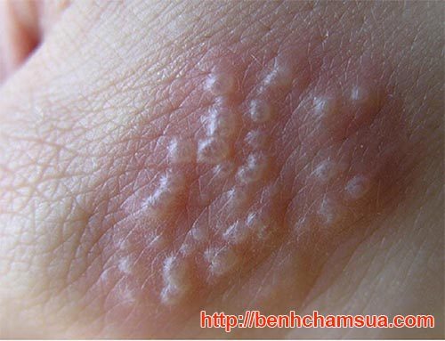 Mụn nước khi bị Eczema