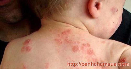 Bệnh Eczema ở trẻ sơ sinh và trẻ nhỏ