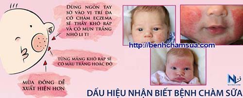 Dấu hiệu trẻ bị chàm sữa mẹ cần biết